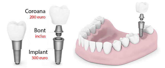 Implant dentar Alpha Bio pret 300 euro